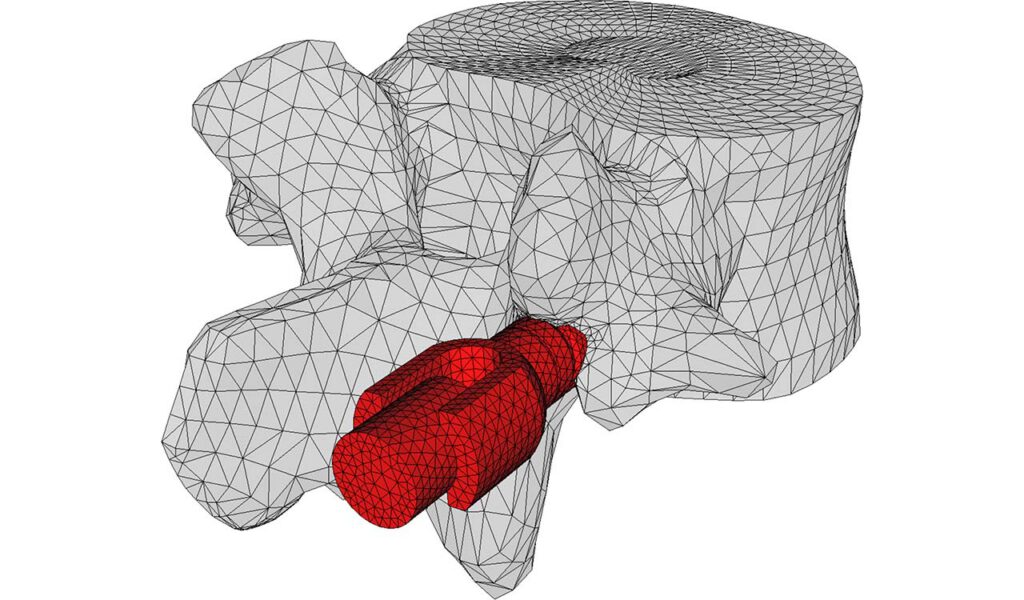 CM2 Intersect® T3 - Vertebra and Implant - Merged Mesh