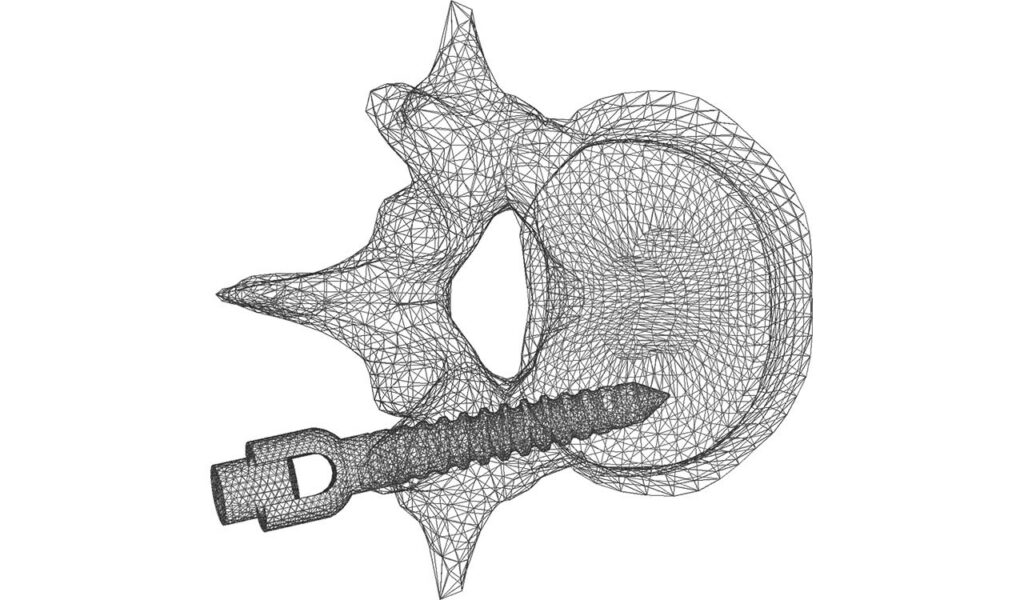 CM2 Intersect® T3 - Vertebra and Implant - Initial Meshes (view #1)